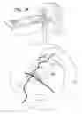 Fig. 22 - Methods and apparatus for dental implantation
