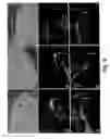 Fig. 05 - Inhibition of invasive remodelling