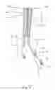 Fig. 06 - Devices, systems, and methods for peripheral arteriovenous fistula creation
