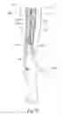Fig. 08 - Devices, systems, and methods for peripheral arteriovenous fistula creation