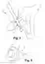Fig. 03 - INJECTION NEEDLE HAVING LATERAL DELIVERY PORTS AND METHOD FOR THE MANUFACTURE THEREOF