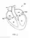 Fig. 02 - Methods and devices for catheter advancement and delivery of substances therethrough