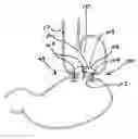 Fig. 01 - Transesophageal gastric reduction method and device for practicing same