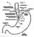 Fig. 02 - Transesophageal gastric reduction method and device for practicing same