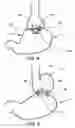 Fig. 04 - Transesophageal gastric reduction method and device for practicing same