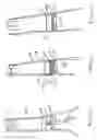 Fig. 07 - Transesophageal gastric reduction method and device for practicing same