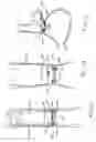 Fig. 08 - Transesophageal gastric reduction method and device for practicing same