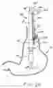 Fig. 09 - Transesophageal gastric reduction method and device for practicing same