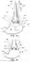 Fig. 11 - Transesophageal gastric reduction method and device for practicing same