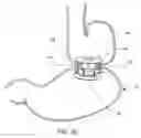 Fig. 12 - Transesophageal gastric reduction method and device for practicing same
