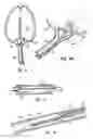 Fig. 04 - Devices and methods using an expandable body with internal restraint for compressing cancellous bone