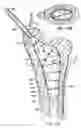 Fig. 08 - Devices and methods using an expandable body with internal restraint for compressing cancellous bone