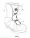 Fig. 02 - Shoelace fastening assembly