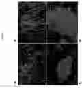 Fig. 02 - Human cancer stem cells