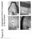 Fig. 74 - Methods of treating neurological conditions with hematopoeitic growth factors