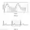 Fig. 03 - Method for Depositing Radiation in Heart Muscle