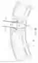 Fig. 05 - Remote Suturing Device
