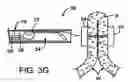 Fig. 07 - APPARATUS FOR GRASPING AND CINCHING TISSUE ANCHORS