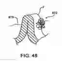 Fig. 46 - APPARATUS FOR GRASPING AND CINCHING TISSUE ANCHORS