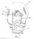 Fig. 02 - Modular occipital plate