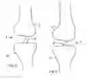 Fig. 02 - Fixation device for surgical repair