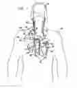 Fig. 02 - Parasympathetic stimulation for prevention and treatment of atrial fibrillation