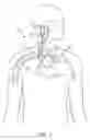 Fig. 02 - ELECTRODE CONTACT CONFIGURATIONS FOR CUFF LEADS