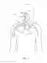 Fig. 02 - CUFF ELECTRODE ARRANGEMENT FOR NERVE STIMULATION AND METHODS OF TREATING DISORDERS