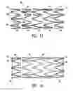 Fig. 09 - Stent with cover connectors