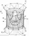 Fig. 01 - Method for implanting a cardiovascular valve