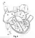 Fig. 09 - Method for implanting a cardiovascular valve