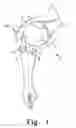Fig. 02 - Orthopaedic stem with protrusion and associated surgical procedure