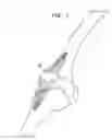 Fig. 07 - Mis patellar preparation
