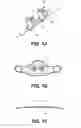 Fig. 02 - Adjustable nasal devices