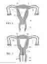 Fig. 02 - Intrauterine fallopian tube occlusion device and method for use