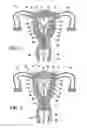 Fig. 03 - Intrauterine fallopian tube occlusion device and method for use