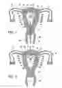 Fig. 04 - Intrauterine fallopian tube occlusion device and method for use