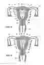 Fig. 06 - Intrauterine fallopian tube occlusion device and method for use