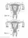 Fig. 07 - Intrauterine fallopian tube occlusion device and method for use