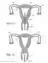 Fig. 08 - Intrauterine fallopian tube occlusion device and method for use