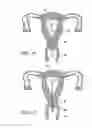 Fig. 10 - Intrauterine fallopian tube occlusion device and method for use