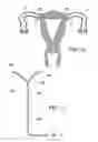 Fig. 12 - Intrauterine fallopian tube occlusion device and method for use