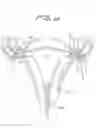 Fig. 08 - Fallopian tube occlusion device