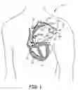 Fig. 02 - System and method for ischemia classification with implantable medical device