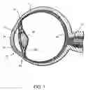 Fig. 02 - FLUID INFUSION METHODS FOR OCULAR DISORDER TREATMENT