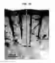 Fig. 49 - Methods And Devices For Fractional Ablation Of Tissue