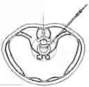 Fig. 01 - CONTRALATERAL INSERTION METHOD TO TREAT HERNIATION WITH DEVICE USING VISUALIZATION COMPONENTS