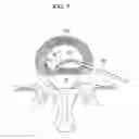 Fig. 08 - CONTRALATERAL INSERTION METHOD TO TREAT HERNIATION WITH DEVICE USING VISUALIZATION COMPONENTS
