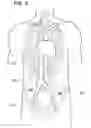 Fig. 03 - Intravenous deep vein thrombosis filter and method of filter placement