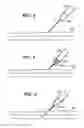 Fig. 04 - Intravenous deep vein thrombosis filter and method of filter placement